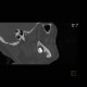 Follicular cyst, adamantinoma: CT - Computed tomography